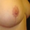 Areola reduction in combination with breast lift, after